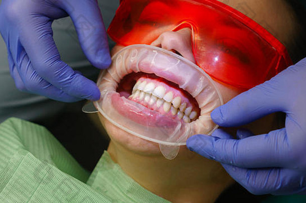 牙医集口扩展器女孩病人检查医生牙科诊所健康护理