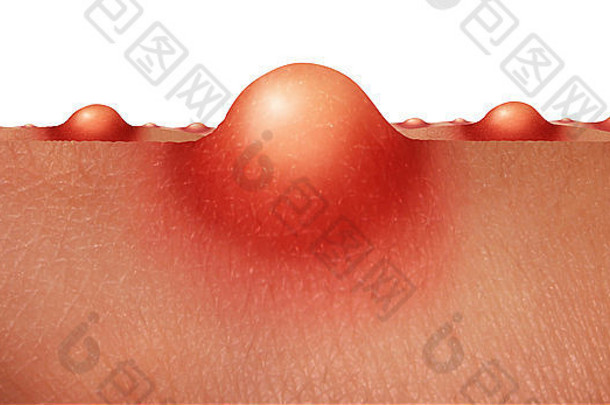 痤疮皮肤健康护理概念集团青春痘溃疡人类皮肤医疗解剖学象征护肤品表皮