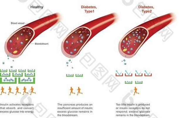 症状高血糖包括频繁的排尿增加渴增加饥饿左未经处理的糖尿病复杂