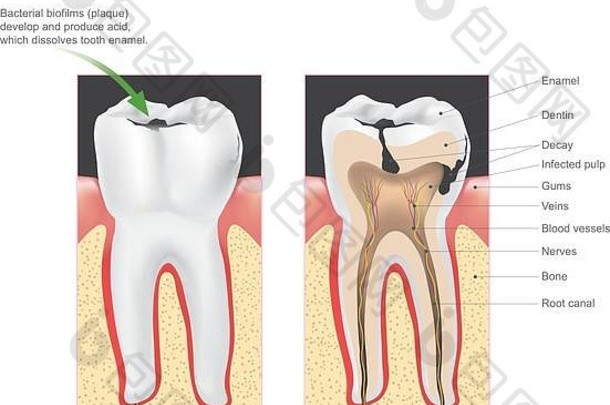 牙科龋齿科学术语牙衰变蛀牙引起的具体的类型细菌生产酸破坏嘟嘟