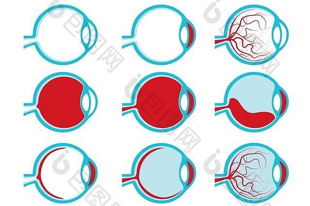 健康的不健康的人类眼睛一边视图插图交叉部分内侧医疗保健虹膜