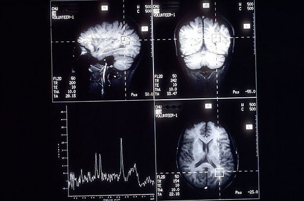 x射线医院磁图像大脑扫描医疗图像头负图像医疗技术