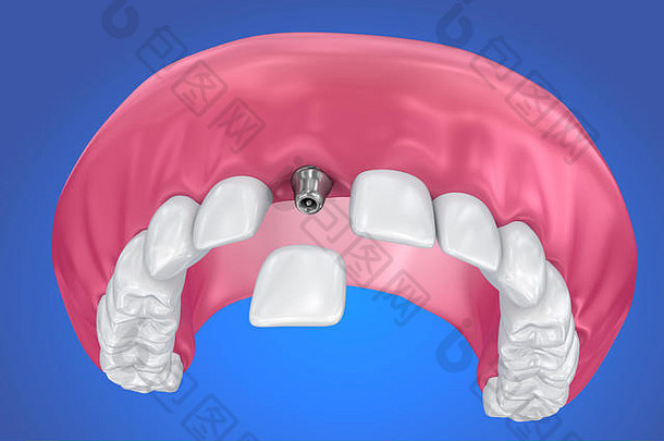 牙植入物皇冠安装过程医学上准确的插图