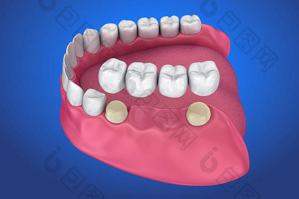 牙支持固定桥医学上准确的插图