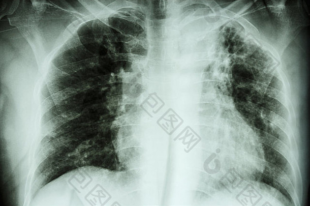 肺肺结核胸部x射线间质渗透左上肺由于分枝杆菌肺结核感染