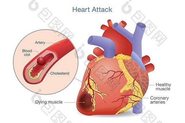 动脉血栓形成的例子是发展为心脏病发作的血块。