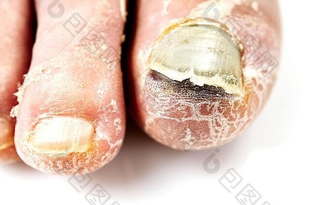 脚上有一颗恶心的钉子。在白色皮肤上分离出的趾甲真菌。脚趾甲酸痛，指甲真菌特写照片