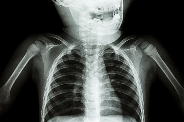 x射线头骨胸部孩子
