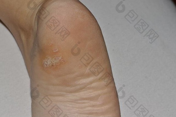 由人乳头瘤病毒（HPV）引起的足跟底部的足底疣的特写镜头。
