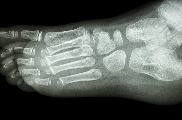 足部侧位x线片：显示正常儿童的足部