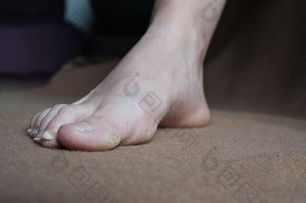 真菌指甲难看、变厚、易碎，在封闭的鞋子内会因压钉而疼痛。真菌感染.皮肤病