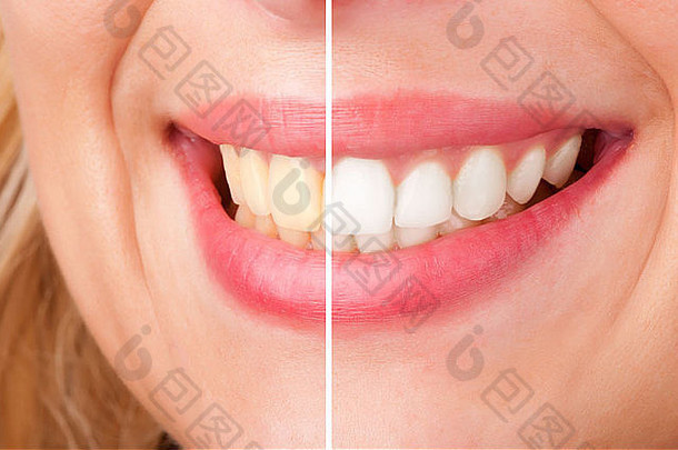 牙科美白过程