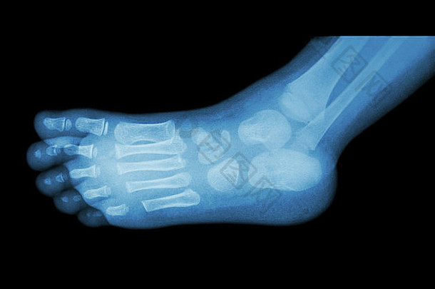 儿童足部x光片（侧视图）（侧视图）