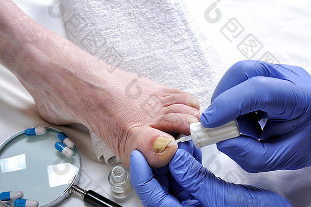 皮肤科医生治疗甲真菌病后的致病真菌作用的指甲。