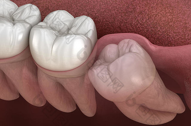 健康牙齿和智齿近中阻生。医学上精确的牙齿3D图解
