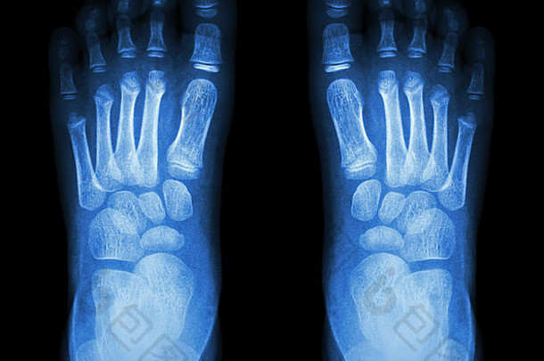 正常儿童足部X射线检查