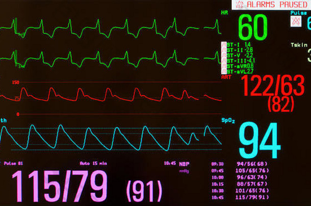 监护仪显示有心律、动脉血压、血氧饱和度和无创血压的ECG。