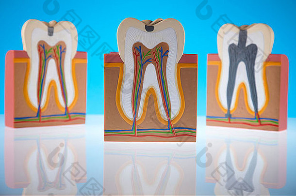 患龋的人牙齿结构