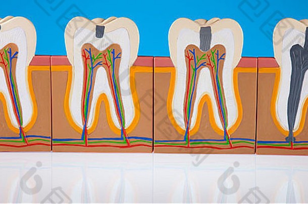 患龋齿的牙齿解剖