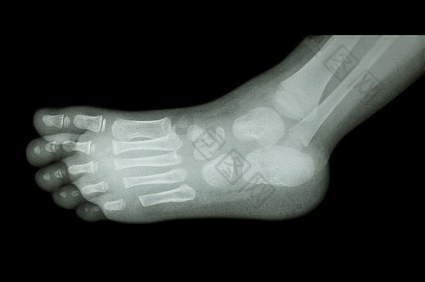 儿童足部x光片（侧视图）（侧视图）