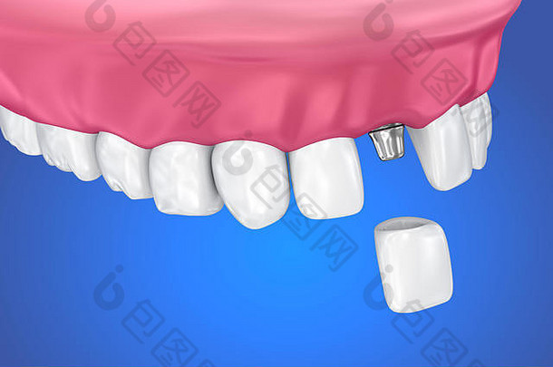 牙种植体和牙冠过程。医学上精确的3D插图