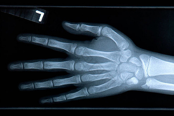 手的特写X光片。