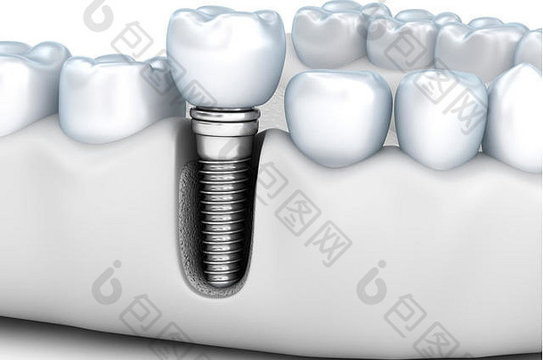 牙齿人体植入物，医学上精确的3D插图白色样式