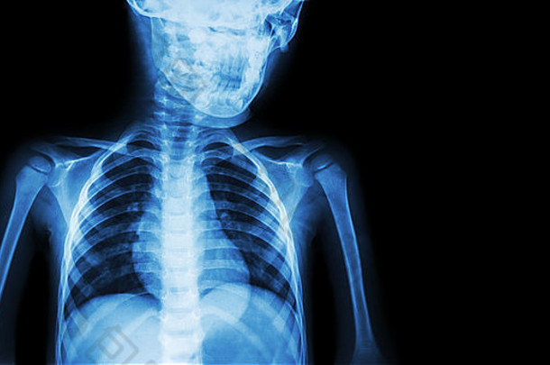 儿童x光片身体及右侧空白区域（医学背景）