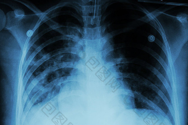 肺结核（TB）：胸部x光片显示由于结核分枝杆菌感染导致双肺肺泡浸润