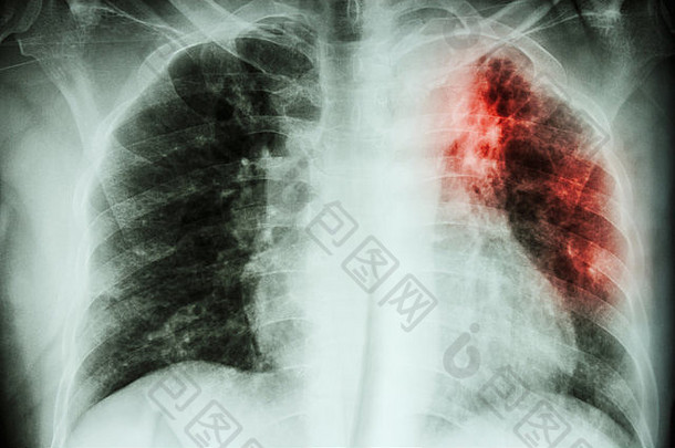 肺结核。胸部X线：结核分枝杆菌感染导致左上肺间质浸润