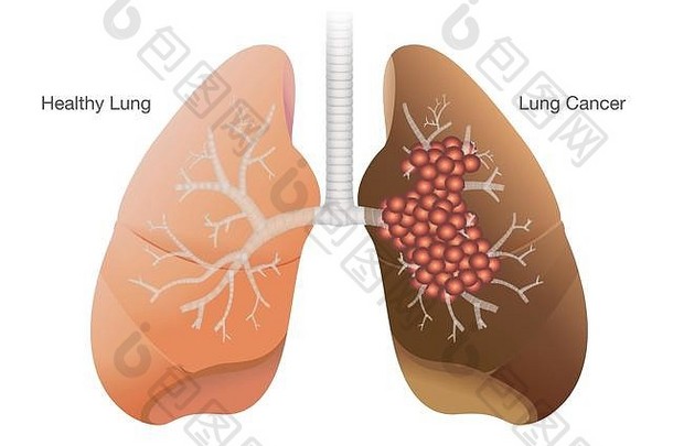 健康肺与癌肺的比较