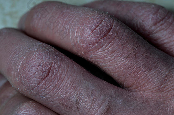 手指因皮肤干燥而闭合。因湿疹而受损的干裂白色皮肤。手指收起来。皮肤干燥的人的手。