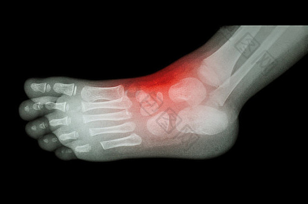 关节炎受伤脚踝电影x射线孩子脚一边视图横向