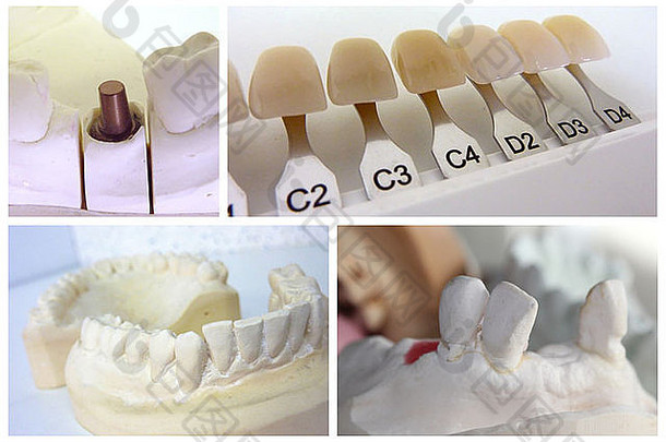 牙科技术员拼贴画石膏口植入物桥台牙科阴影指南