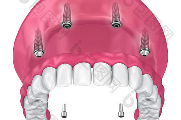 覆盖义齿应在种植体附件上。三维插图
