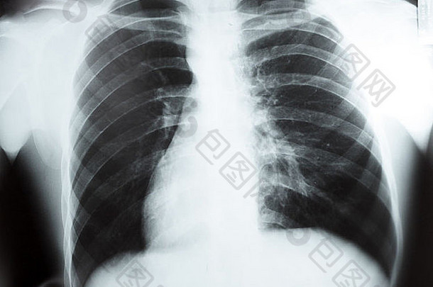 预览机上的胸部X光片，黑白