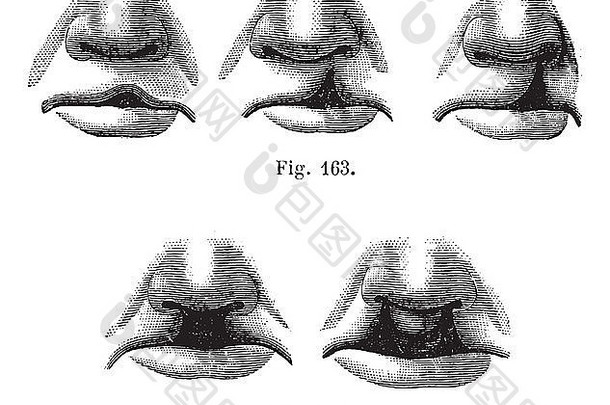 图163。单纯唇裂的程度，图164。双唇唇裂，复古雕刻插图。马加辛·皮托雷斯1875年。