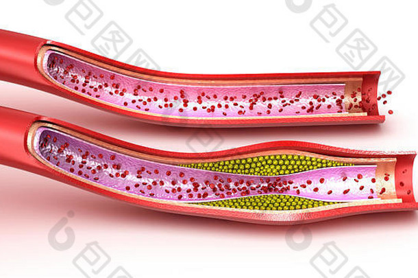 血管：正常和胆固醇受损的血管。三维渲染