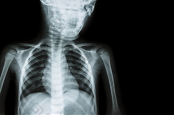 儿童x光片身体及右侧空白区域（医学背景）