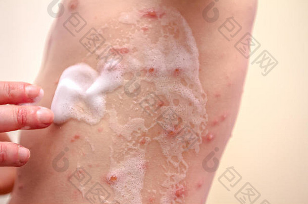 感染水痘的儿童皮肤正在使用消毒泡沫进行治疗。