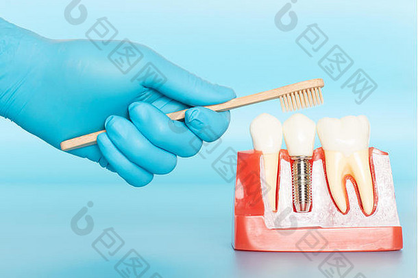 塑料样品牙科植入物比较自然牙齿病人承认差异类型牙齿使决定贝佛