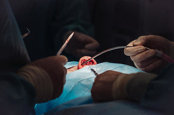 鼻子整容手术。外科医生割肉