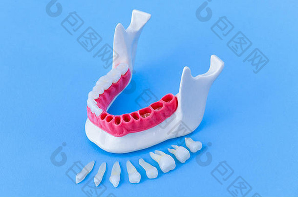 在蓝色背景上隔离牙齿种植体和牙冠过程。医学上精确的3D插图