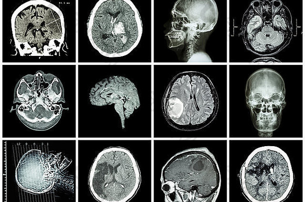 脑部疾病收集（脑部CT扫描和MRI：显示脑梗死、脑出血、脑肿瘤、基底动脉瘤）
