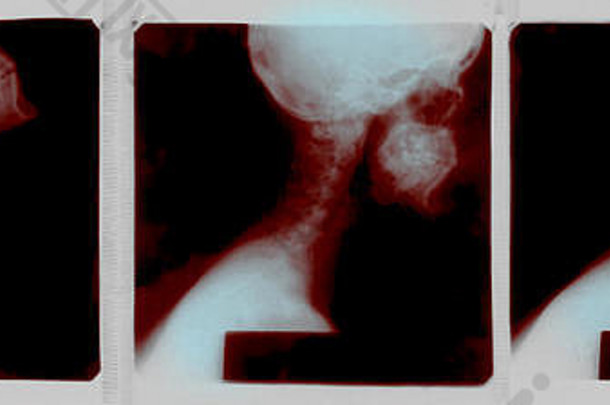 人体颈椎的X射线图像