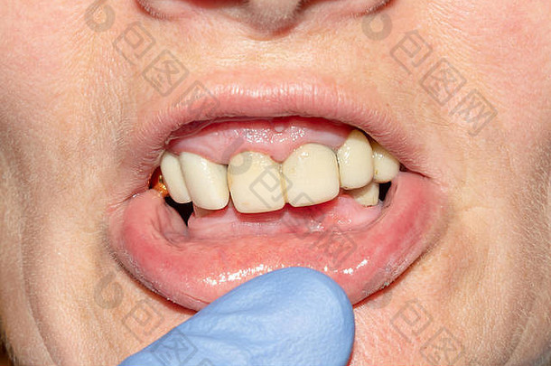 修复一颗腐烂的牙齿。牙科临床中的治疗美学牙科学概念
