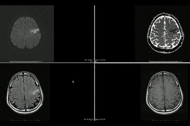 左额叶上切面脑梗死的磁共振成像（MRI）