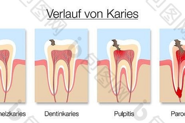 龋齿阶段信息图表德国标签发展牙衰变搪瓷牙质龋齿牙髓炎牙周炎