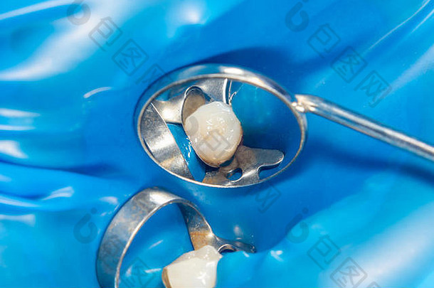 龋齿。使用rabbders用牙科复合光聚合材料填充。牙科诊所的牙科治疗理念