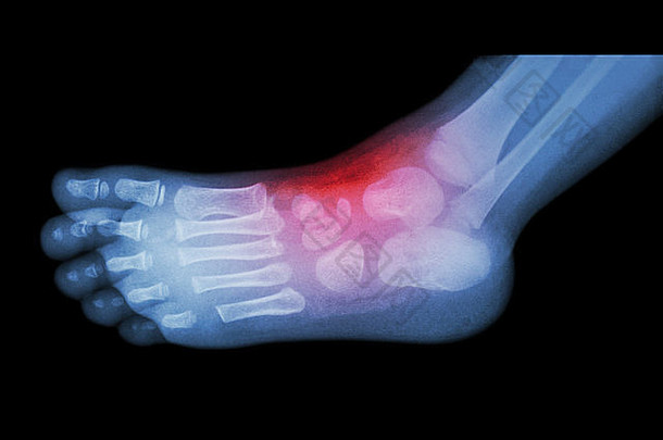 关节炎和踝关节损伤：儿童足部x线胶片（侧视图）（侧视图）
